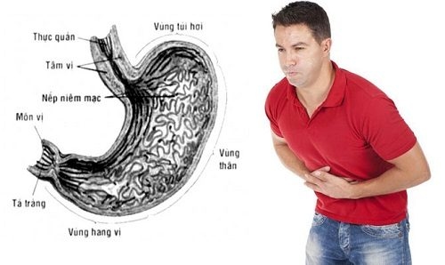 Các bệnh ở dạ dày nếu không điều trị kịp thời có thể gây biến chứng nguy hiểm như xuất huyết dạ dày hoặc thủng dạ dày