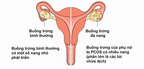 Đa nang buồng trứng là một bệnh lý thường gặp, ảnh hưởng đến sức khỏe sinh sản nữ giới