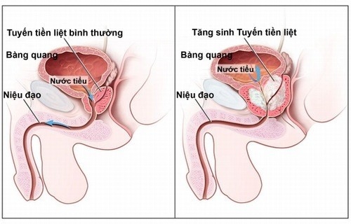 Tiểu nhiều lần có thể là dấu hiệu viêm tuyến tiền liệt