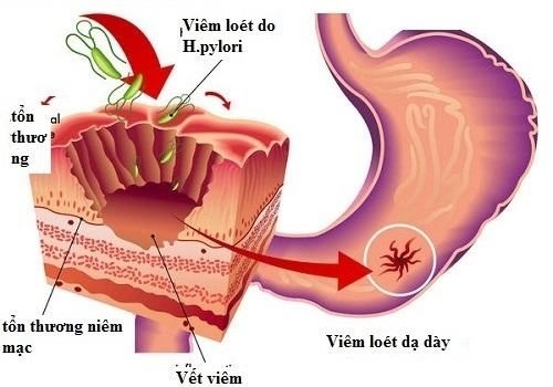 nguyên nhân chính xác gây ung thư dạ dày vẫn chưa được kết luận cụ thể nhưng có một vài yếu tố được cho là căn nguyên gây bệnh như vi khuẩn HP.