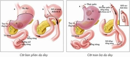 Mổ dạ dày là phương pháp phẫu thuật giúp lấy đi một phần hoặc toàn bộ dạ dày. 