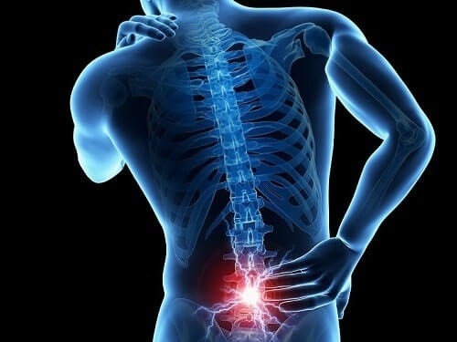 Đau lưng dưới có thể do thoát vị đĩa đệm