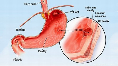 Phù nề dạ dày nên ăn gì - Nguyên nhân