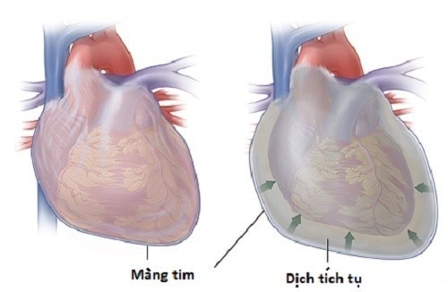  tràn dịch màng tim có nguy hiểm đe dọa tính mạng người bệnh cần được phát hiện sớm và điều trị hiệu quả