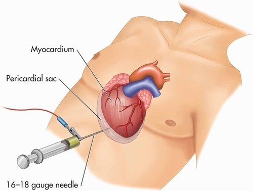 Điều trị tràn dịch màng tim đúng cách và kịp thời tránh biến chứng nguy hiểm
