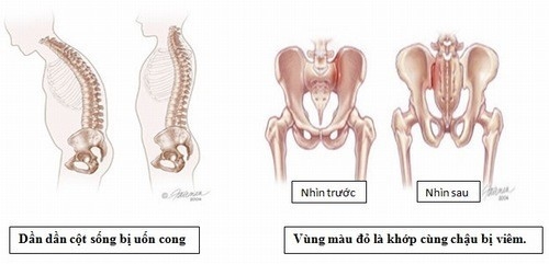 Viêm khớp cùng chậu có thể gây ảnh hưởng đến sức khỏe