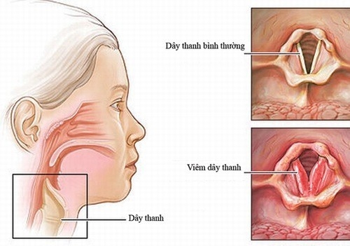 Viêm thanh quản cần làm gì? gây ảnh hưởng đến sức khỏe
