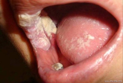 Triệu chứng cảnh báo bệnh lậu họng cần được phát hiện sớm và điều trị hiệu quả