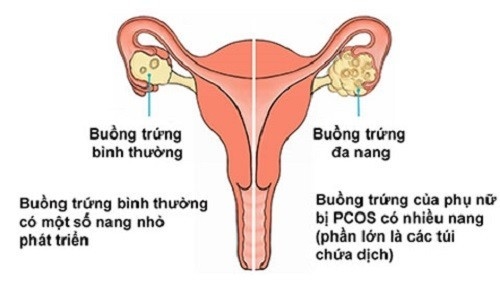 Hội chứng buồng trứng đa nang là gì? Triệu chứng nhận biết