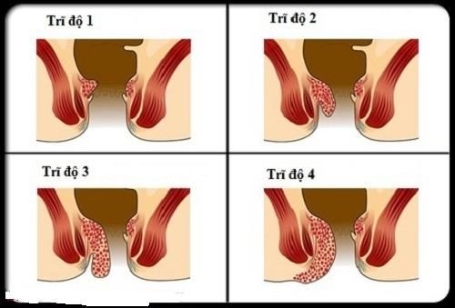 Bệnh trĩ được chia thành nhiều cấp độ, ở độ nhẹ không cần phải phẫu thuật
