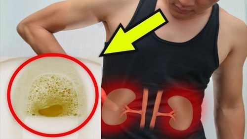 Nước tiểu có bọt có thể do vấn đề đường tiết niệu