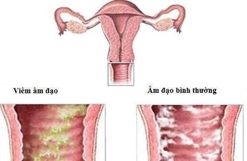 Viêm nhiễm vùng kín có thể do nhiều nguyên nhân gây nên cần được chẩn đoán chính xác nguyên nhân để điều trị hiệu quả