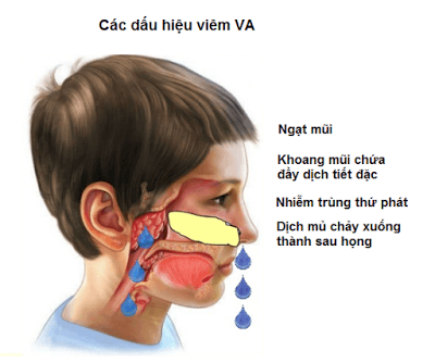 Các biểu hiện viêm VA ở trẻ mà cha mẹ NÊN BIẾT