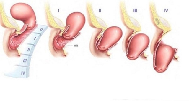 Hình ảnh tử cung bị sa biến chứng ảnh hưởng sức khỏe