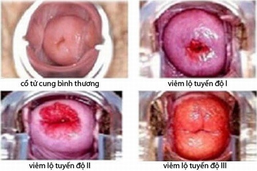 Cấp độ 1, diện tích viêm nhiễm ở cổ tử cung chỉ khoảng 1/3 diện tích cổ tử cung.Cấp độ 1, diện tích viêm nhiễm ở cổ tử cung chỉ khoảng 1/3 diện tích cổ tử cung.Cấp độ 1, diện tích viêm nhiễm ở cổ tử cung chỉ khoảng 1/3 diện tích cổ tử cung.