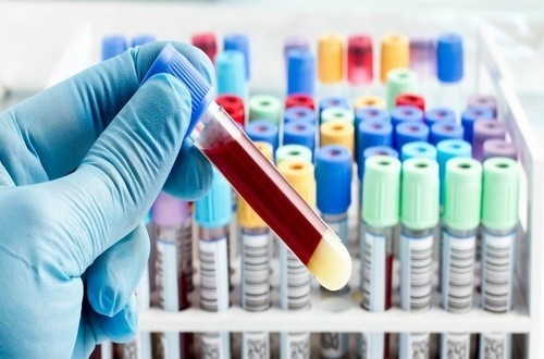 Xét nghiệm máu là chỉ định cần thiết trong chẩn đoán và điều trị bệnh