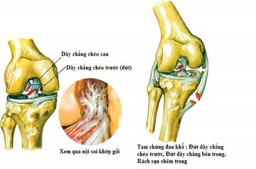 Đứt dây chằng gối nguy hiểm không?