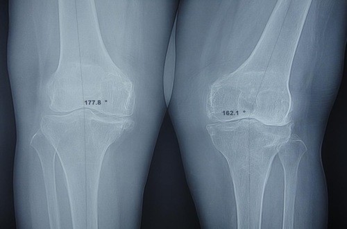 Chụp X quang khớp gối giúp chẩn đoán chính xác các bệnh lý ở khớp gối