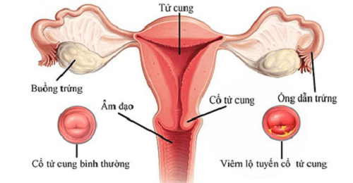 Lộ tuyến cổ tử cung có nguy hiểm không?