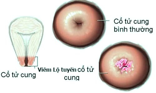 lo-tuyen-co-tu-cung-co-nguy-hiem-khong-3