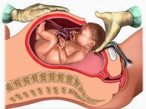 Mổ đẻ như thế nào?em không biết mổ đẻ như thế nào