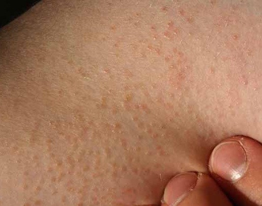 Bệnh xảy ra khá phổ biến ở các vận động viên đổ mồ hôi nhiều vì đây là môi trường khá hoàn hảo cho vi khuẩn gây ra tình trạng viêm nang lông phát triển mạnh
