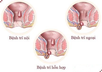Trĩ được chia làm 3 dạng: Trĩ nội, trĩ ngoại, trĩ hỗn hợp
