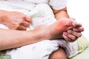 Bệnh Gout được chia làm 2 giai đoạn: giai đoạn sớm và giai đoạn muộn