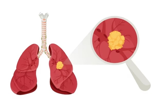 Ung thư phổi dạng tế bào nhỏ: ít phổ biến nhưng rất nguy hiểm