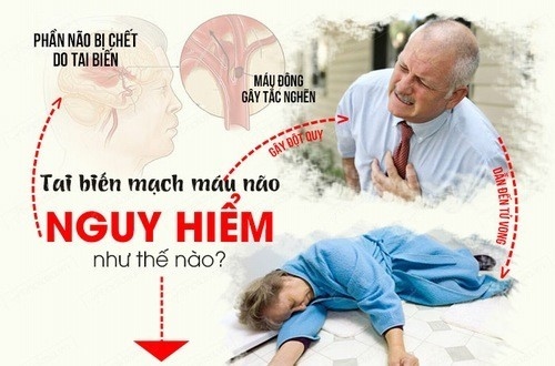 Tai biến mạch máu não gây biến chứng nghiêm trọng đe dọa tính mạng người bệnh