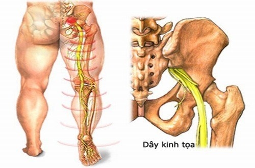 Đau thần kinh tọa những điều cần biết