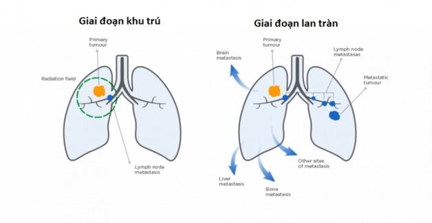 Ung thư phổi dạng tế bào nhỏ: ít phổ biến nhưng rất nguy hiểm