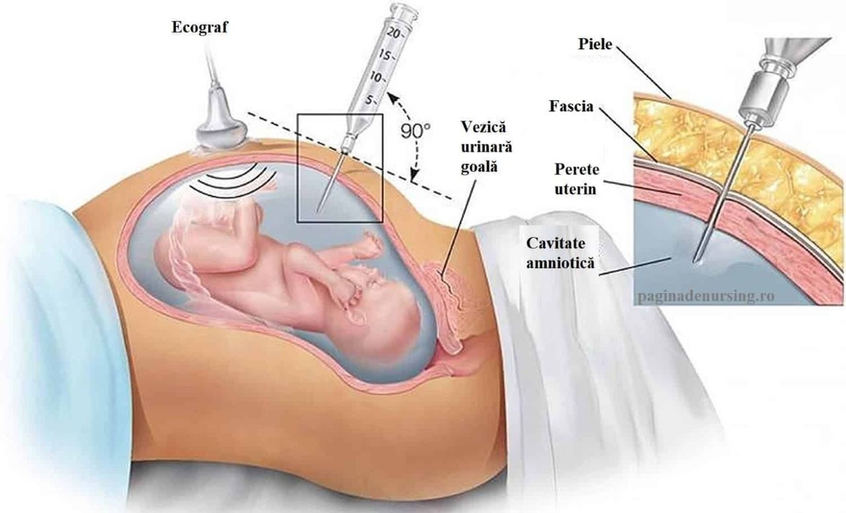 Mẹ bầu có biết Kỹ thuật bấm ối được thực hiện thế nào không?