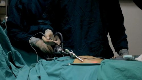 Phẫu thuật nội soi hạn chế sẹo, nhanh hồi phục và giảm biến chứng so với phẫu thuật mổ mở