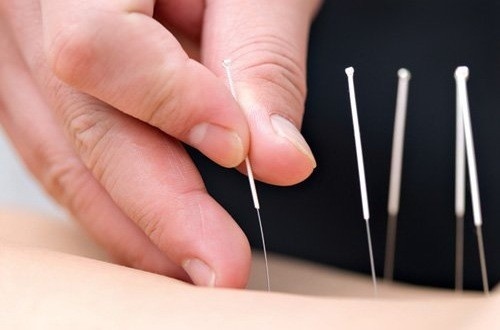 Châm cứu là một trong những phương pháp phục hồi sau tai biến hiệu quả