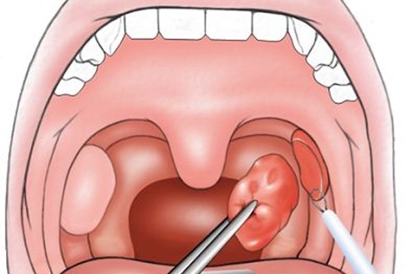 Cắt amidan khi nào? gây bệnh xâm nhập qua đường ăn