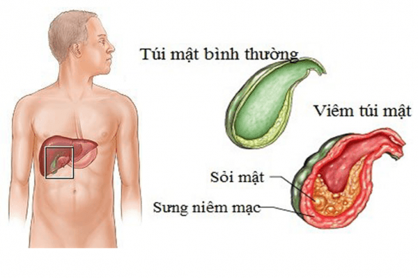 Cắt túi mật là chỉ định cần thiết trong điều trị sỏi túi mật