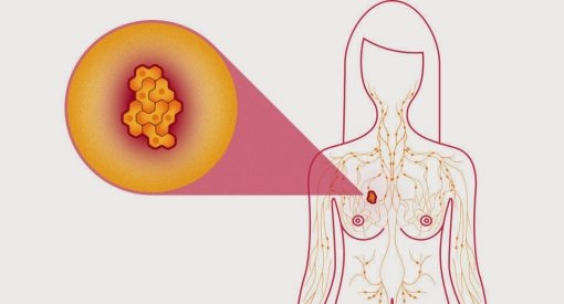 Hóa trị ung thư vú bao nhiêu lần?