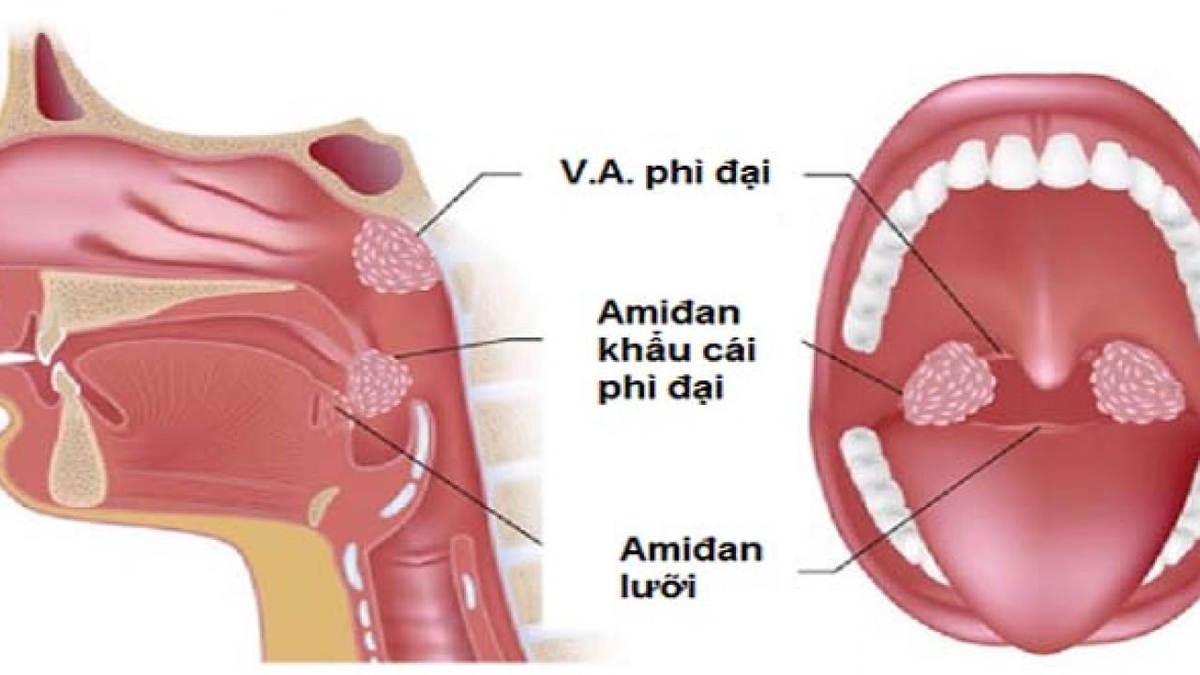 Nạo VA bằng công nghệ plasma rút ngắn thời gian hồi phục
