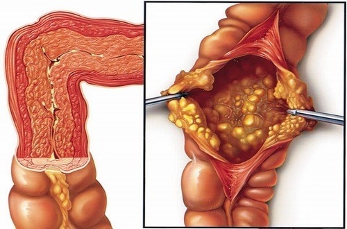 Trị không dứt điểm khiến viêm đại tràng tái phát gây nguy hiểm