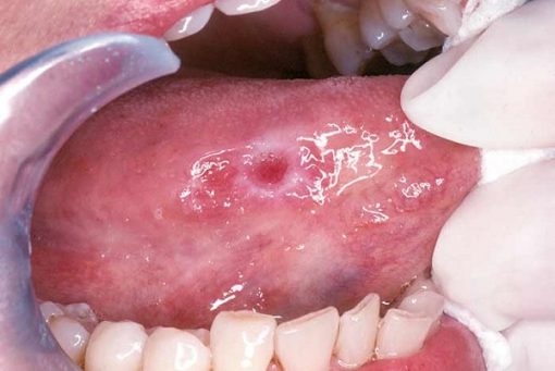 Ung thư lưỡi có lây không?