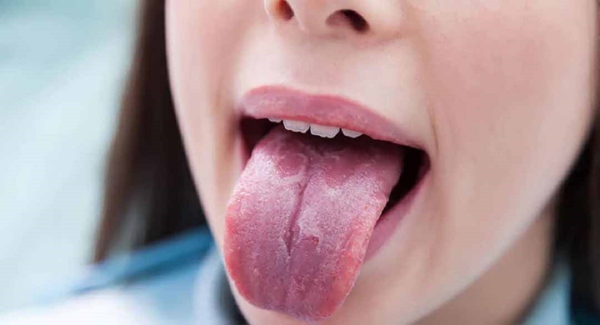 Hình ảnh ung thư lưỡi giai đoạn đầu