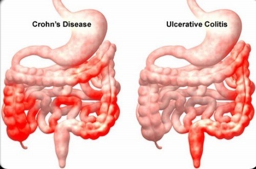 Viêm đường ruột cần được phát hiện sớm và điều trị hiệu quả