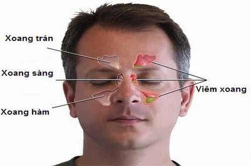 Viêm xoang trán cần được phát hiện sớm và điều trị hiệu quả