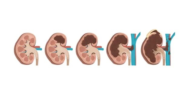 Ung thư thận giai đoạn di căn: Biểu hiện và tiên lượng sống