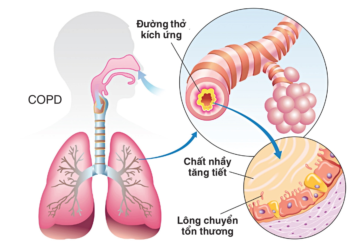 Dịch nhầy đường hô hấp nguyên nhân do đâu?
