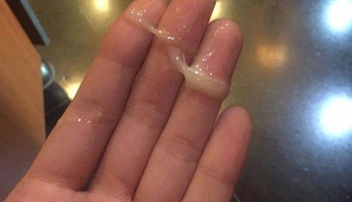 khí hư có màu vàng là dấu hiệu bệnh lý ở phụ nữ