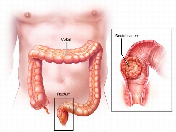 Các bệnh lý về trực tràng