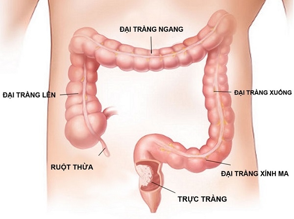 Viêm trực tràng là tình trạng trực tràng bị tổn thương viêm nhiễm