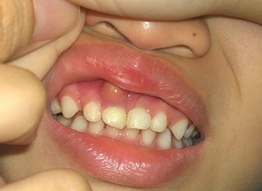 Viêm lợi cũng là một trong những nguyên nhân khiến bạn chảy máu chân răng